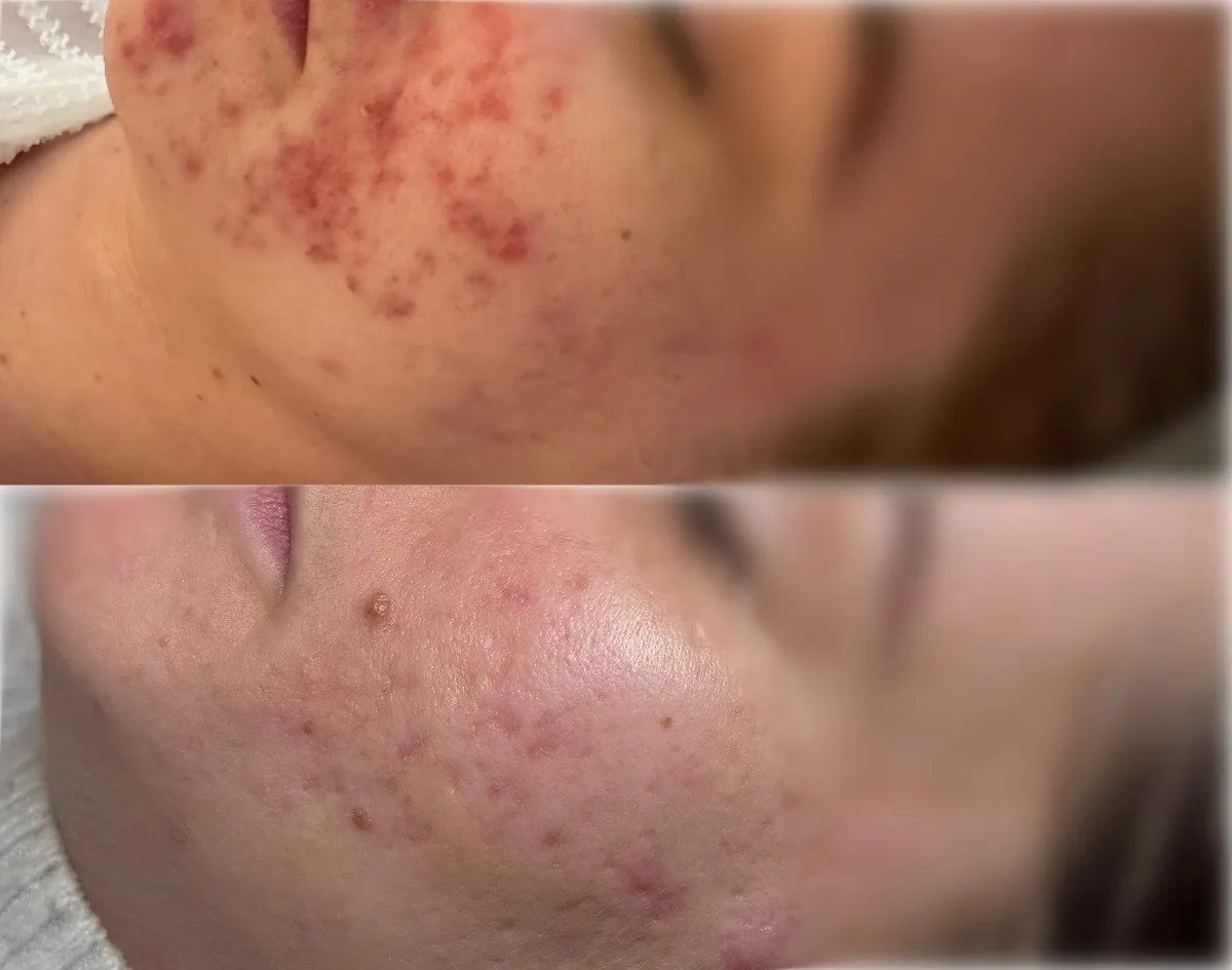 Cheek with many red, inflamed acne spots, and below it the same cheek with far fewer, flatter spots.