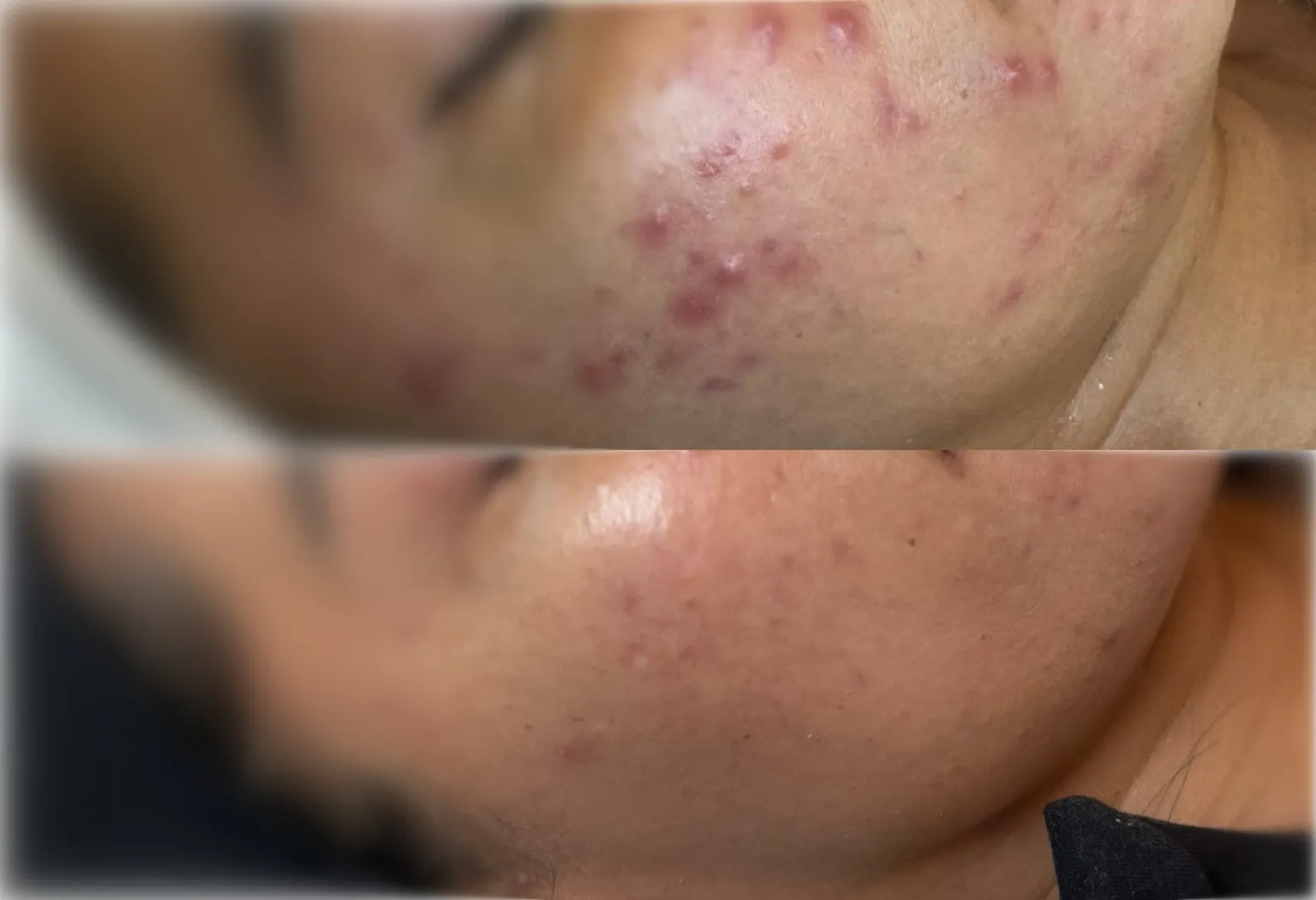 Cheek and jaw with raised red acne spots, and below it the same area with smoother, calmer skin.