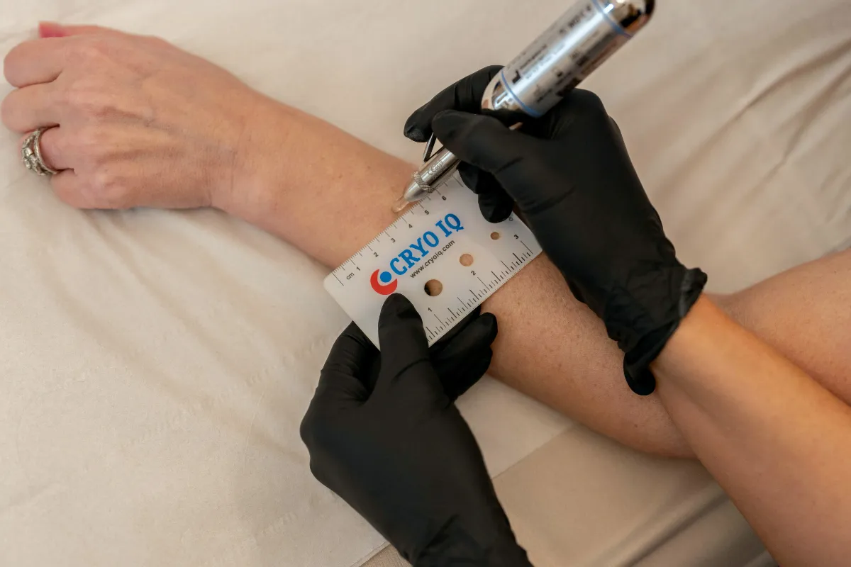 Cryotherapy Skin Tag & Lesion Removal at The London Road Clinic, Newark