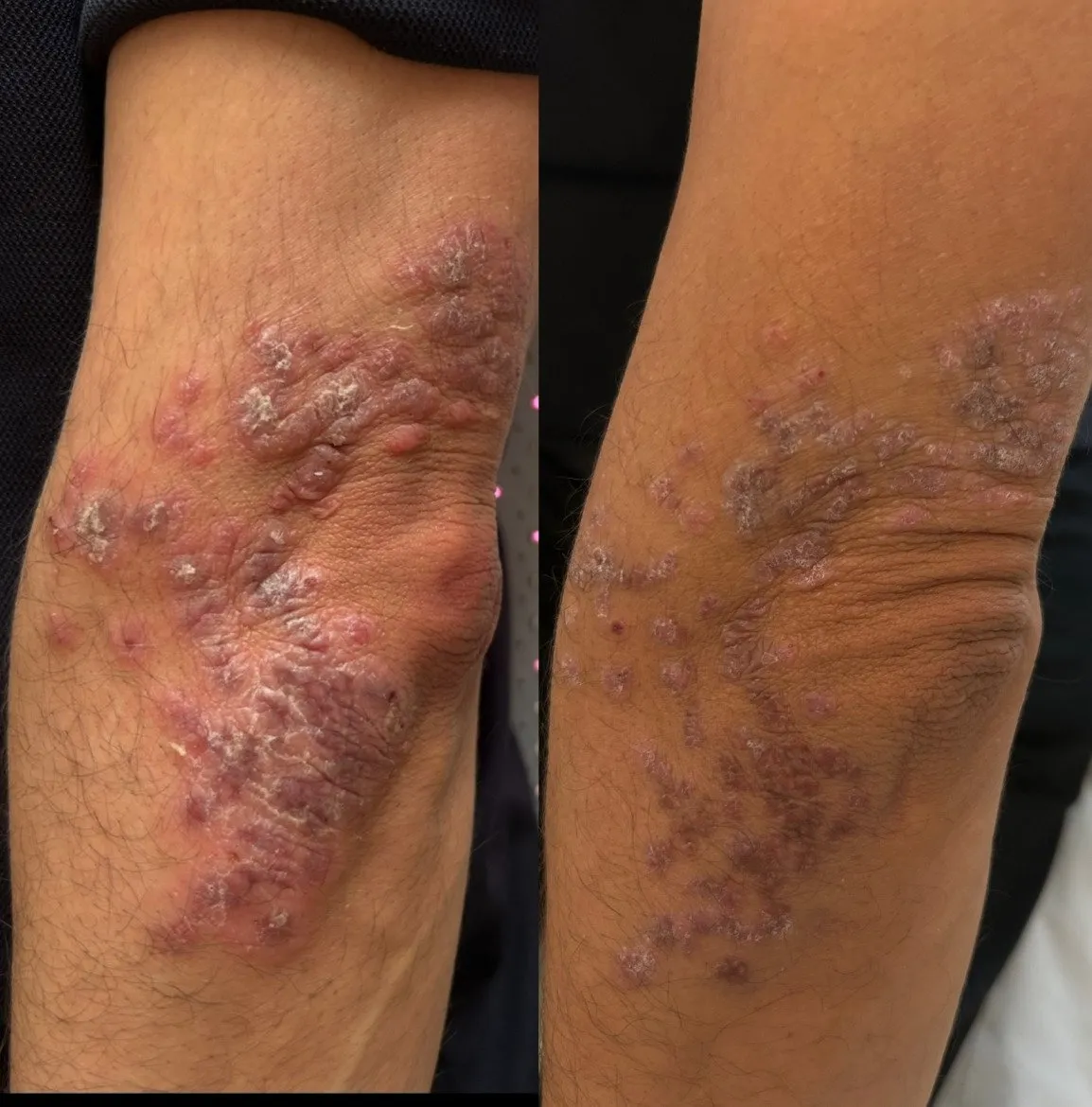 Inner elbow with raised, scaly, inflamed patches, and beside it the same area with flatter, less scaly skin.