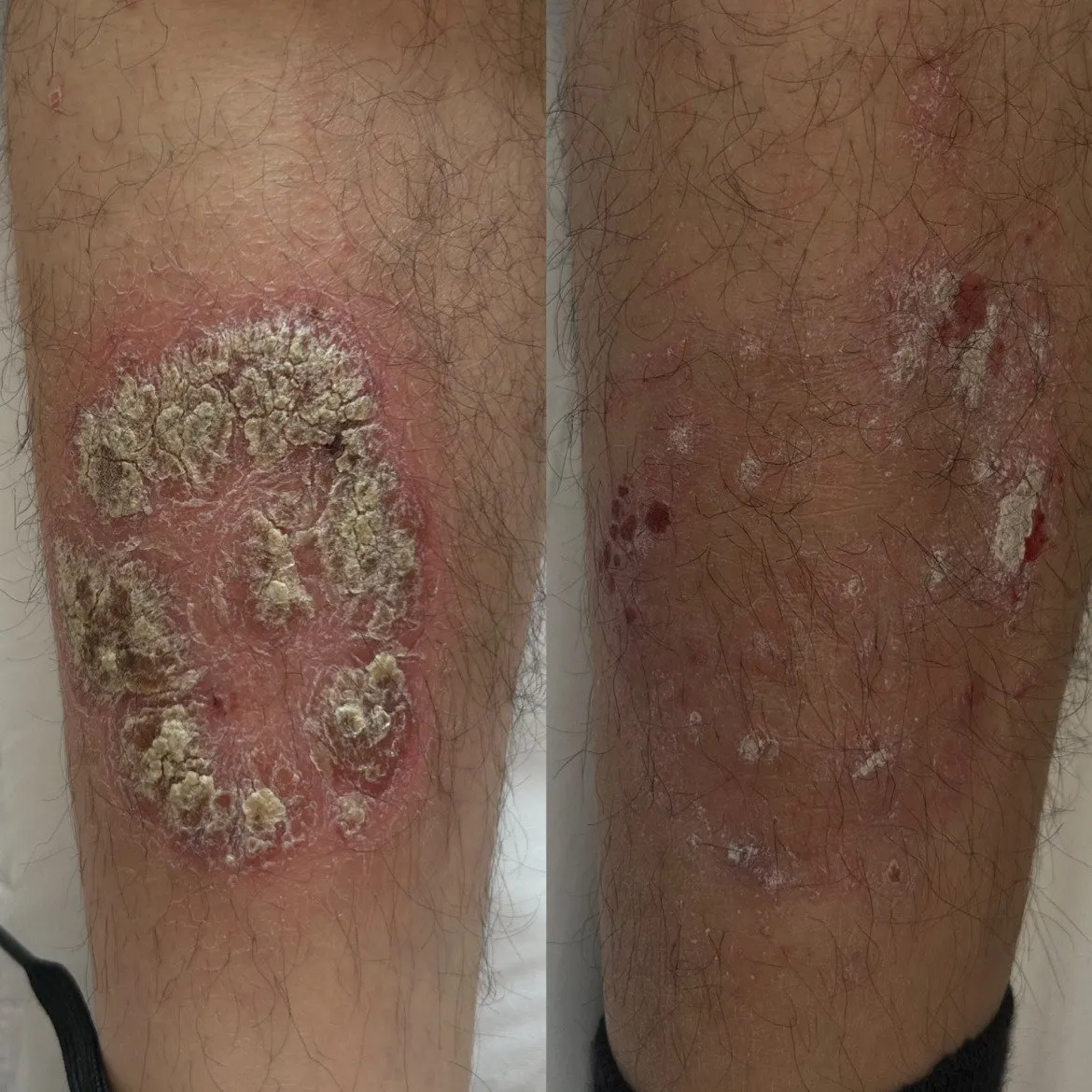Shin with a thick, scaly, inflamed plaque, and beside it the same shin with the plaque much reduced.