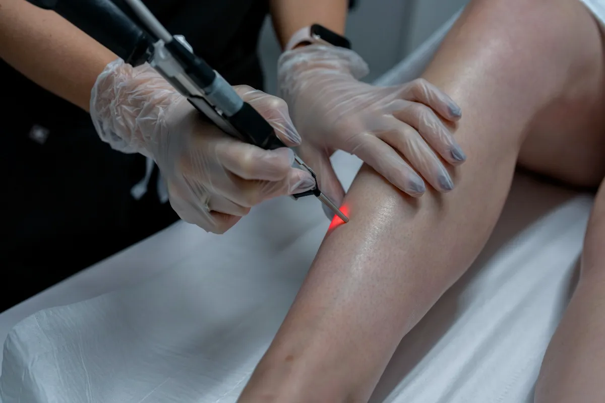 Laser Hair Removal (Cynosure) at The London Road Clinic, Newark