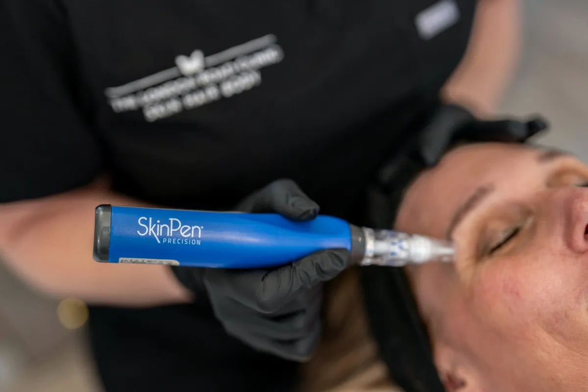 SkinPen Microneedling at The London Road Clinic, Newark